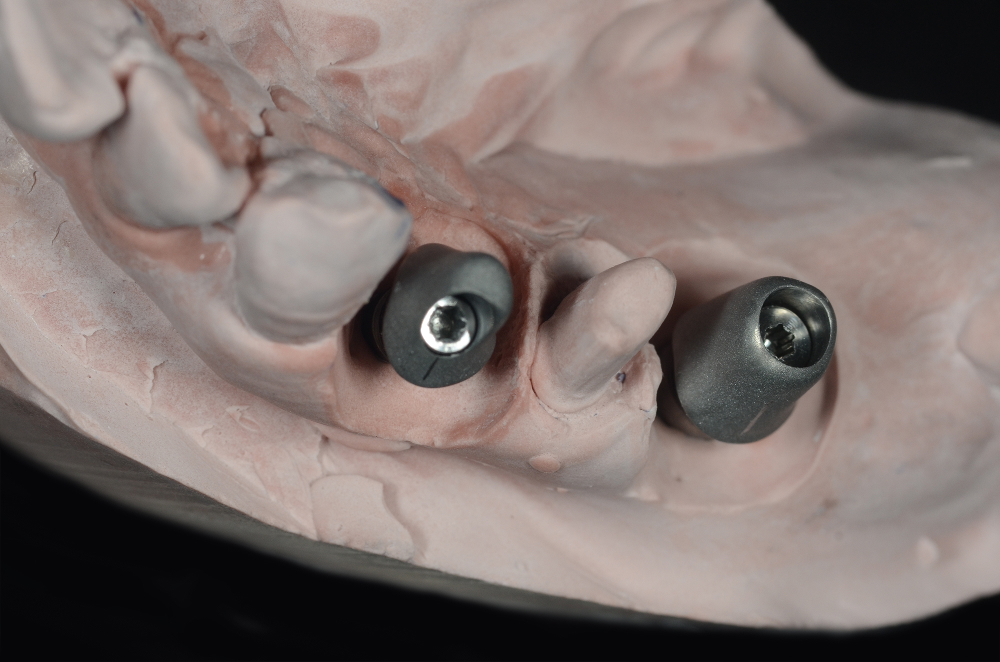 Zirconia Bridge on Titanium Abutments